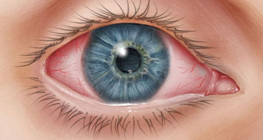 Close-up of an eye with conjunctivitis or pink eye.