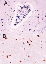 Thumbnail of Histopathologic and immunohistochemical evidence of H5N1 virus in tiger: A) Mild multifocal nonsuppurative encephalitis; B) Influenza A virus antigen in nuclei and cytoplasm visible as brown staining.