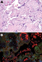 Thumbnail of Tissue sample from 30-year-old primigravida patient exposed to seasonal influenza (H1N1). A) Intervillous (maternal) spaces with clusters/sheets of histiocytes (chronic intervillositis) and fibrotic fetal chorionic villi with Hofbauer cells–histiocytic inflammation (hematoxylin and eosin stain, original magnification ×200). B) Dual-stained immunofluorescent assay showing antibodies to influenza A virus (H1N1) (tetramethylrhodamine isothiocyanate, red) and cytokeratin (fluorescein is
