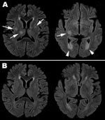 Thumbnail of Magnetic resonance imaging with fluid-attenuated inversion recovery sequence of brain for adult patient with pandemic (H1N1) 2009 encephalitis, Taiwan. A) On day 9 after symptom onset, scattered asymmetric focal hyper signal intensities over bilateral putamen and right thalamus (arrow on the left image) and ventriculitis over bilateral occipital horns (arrow head over right image) are seen. B) By day 24, the lesions had resolved.