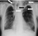 Thumbnail of Chest radiograph showing bilateral upper lobe chronic pulmonary aspergillosis, which can be easily mistaken for pulmonary tuberculosis. White arrows indicate areas of abnormality (some pleural thickening and opacification) in both apices, which are similar, although slightly more obvious, to findings in pulmonary tuberculosis. Black arrow indicates the trachea pulled to one side by the contraction and fibrosis on that side. Image used with permission of David Denning (©2016, all rig
