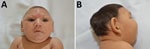 Thumbnail of Characteristic phenotype of fetal brain disruption sequence in infants with probable congenital Zika virus syndrome, Sao Luís, Brazil, 2015–2016. A) Craniofacial disproportion and biparietal depression. B) Prominent occiput.