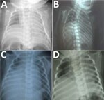 Thumbnail of Chest radiographs of infants with congenital Zika syndrome, demonstrating elevation of the right hemidiaphragm. Panels A–D represent patients 1–4, respectively. In each instance, only the right hemidiaphragm was noticeably elevated. All patients also had arthrogryposis (including talipes equinovarus) and died from complications related to progressive respiratory failure.