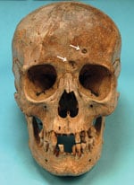 Thumbnail of The skull of Maria Salviati in frontal view. Cavitations on the frontal bone are apparent. (Archive of the Division of Paleopathology. University of Pisa.) 