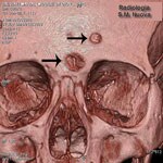 Thumbnail of Volume rendering of the skull of Maria Salviati. Two destructive osteolytic inflammatory processes, in advanced reparative phase (circumvallate cavitations), are apparent. (Archive of the Division of Paleopathology. University of Pisa.) 