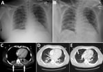 Thumbnail of Radiographs (A, B) and computed tomography (C–E) images of chest of organ donor with Francisella tularensis infection, United States, 2017. Images were taken after brain death. A) Anteroposterior view with patient in upright position, taken on day of admission; B) anteroposterior view with patient in supine position, taken on hospital day 10. C) Small bibasilar pleural effusions with adjacent subsegmental atelectasis versus pneumonia in the lower lobes (arrows); D) 3-cm round focus 