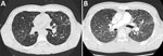 Thumbnail of Computed tomography (CT) scans of a coronavirus disease (COVID-19) patient with sarcoidosis who had been receiving long-term hydroxychloroquine treatment, France. A) Thoracic CT scan from November 2019, showing baseline pulmonary sarcoidosis lesions. B) Thoracic CT scan performed April 4, 2020, showing diffuse ground-glass opacities characteristic of COVID-19.