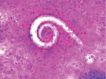 Bronchoalveolar lavage sample showing larval forms of Strongyloides stercoralis in a patient with COVID-19, United States. Original magnification ×200. 