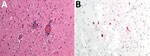 Histopathologic findings from the brain of a wild chamois with tick-borne encephalitis virus found in the Lombardy region of Italy in May 2023. A) Severe, chronic, nonpurulent meningoencephalitis characterized by perivascular lymphohistiocytic cuffs. Hematoxylin-eosin stain; original magnification ×20. B) Neuronal positivity for tick-borne encephalitis virus. Immunohistochemistry; original magnification ×20.