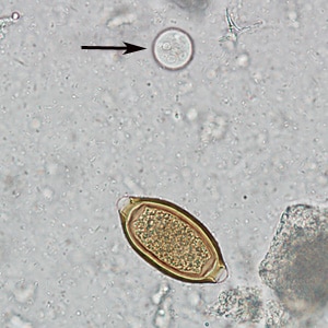 Figure F: Egg of <em>T. trichiura</em> in an unstained wet mount of stool. Notice also the presence of a cyst of <em>Entamoeba coli</em> (arrow).