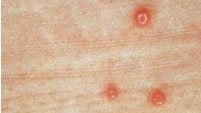 Close-up of three molluscum sores on a person's skin.