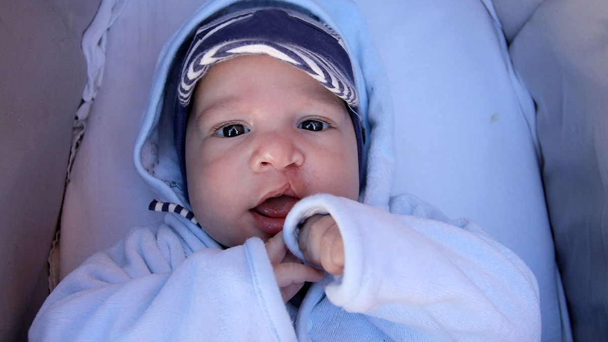 Baby with cleft lip in warm clothes
