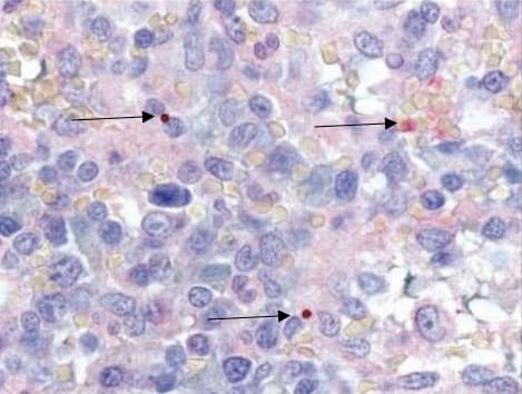 Immunohistochemical stain demonstrating Anaplasma phagocytophilum morulae (red) in the spleen of a patient with splenic rupture associated with anaplasmosis