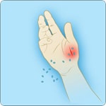 Illustration of hand with anthrax spores entering a cut.