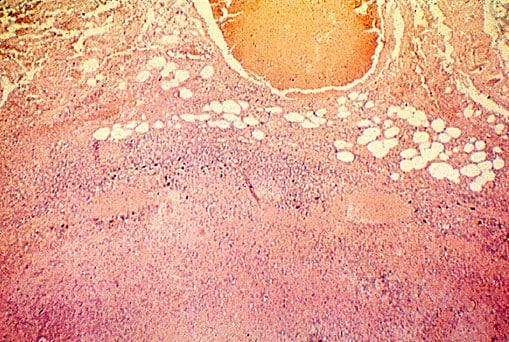 This is a photomicrograph of a hematoxylin-eosin (H&E)-stained lymph node tissue sample, harvested at the time of autopsy, from a 33 year-old patient, who had succumbed to a fatal case of inhalation anthrax, caused by the bacterium, Bacillus anthracis.