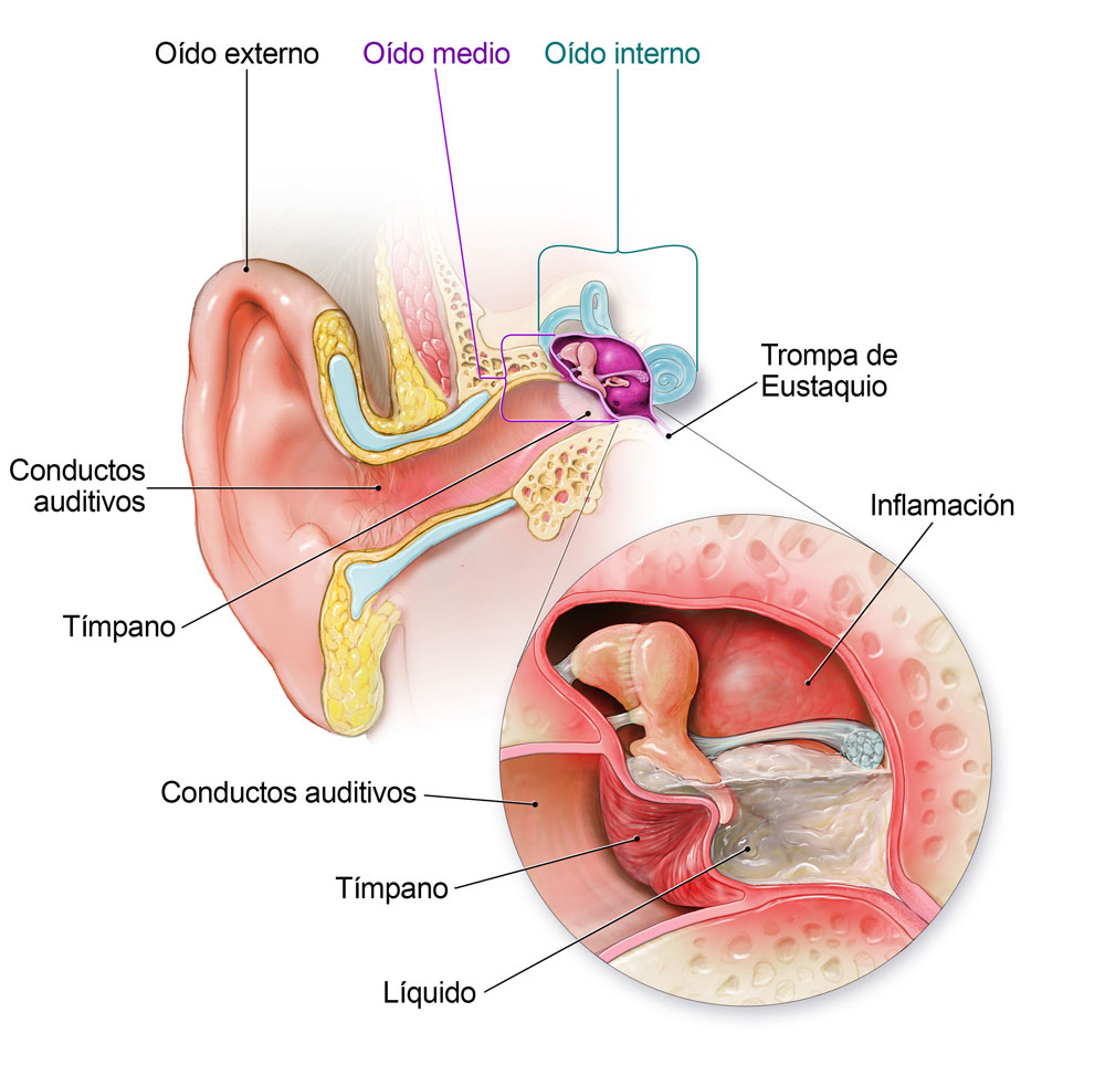 Un oído sano, que incluye el oído externo, medio e interno. Un oído infectado que muestra inflamación y líquido en el oído.