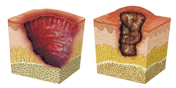 Illustration of skin section with ulcer.