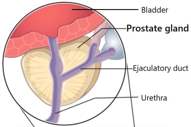 Illustration of the prostate along with the bladder, prostate gland, ejaculatory duct, and urethra.