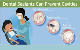 School Sealant Programs | Division of Oral Health | CDC