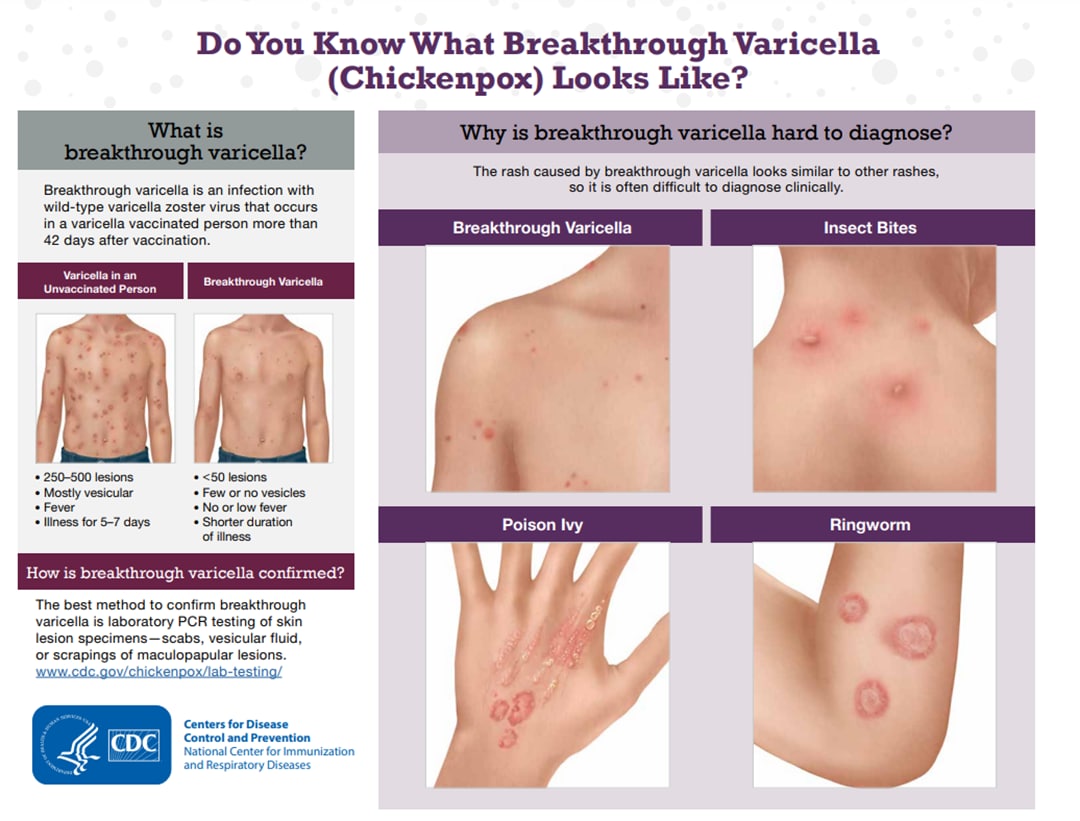 Learn what breakthrough varicella (chickenpox) looks like in vaccinated people.