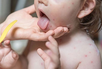 Toddler with chickenpox.