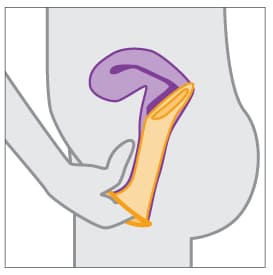 Condón femenino colocado correctamente con el pene dentro de la vagina.