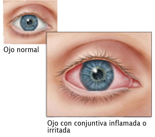 Un ojo normal y otro con conjuntivitis.