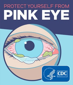 Illustration of a red and watery eye showing symptoms of pink eye, including discharge