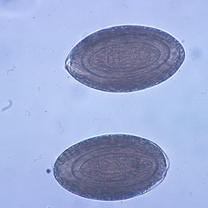 Figure A: Eggs of <em>M. hirudinaceous</em> in an unstained wet mount of stool.