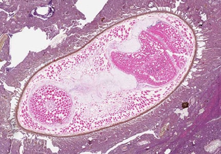 Figure B: Seed in an intestinal biopsy specimen. Such object may be confused with parasites, such as intestinal trematodes or <em>Balantidium coli</em>. The boxy, compartmentalized cells are characteristic of plant tissue. Image courtesy of the Children's Hospital of Eastern Ontario, Canada.