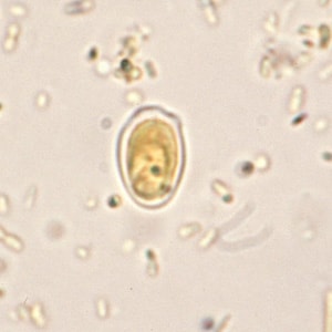 Figure D: Fungal spore in concentrated wet mounts of stool. Such spores may be confused for protozoa such as <em>Giardia</em> or <em>Chilomastix</em>.