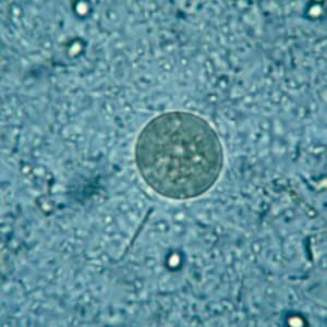 Figure E: Fungal spore in a wet mount of stool. Such spores may be confused for the cysts of <em>Entamoeba</em> spp.