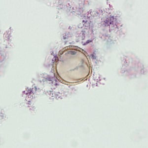 Figure D: Pollen grain in a trichrome-stained stool specimen. In this focal plane, the grain looks like the striated egg of <em>Taenia</em> sp. However, notice the lack of refractile hooks.