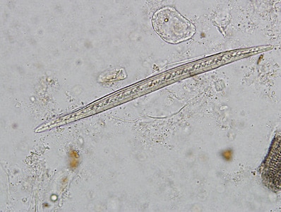 Figure C: Plant hair in a concentrated wet mount of stool. Plant hairs can be common in stool and may be confused for the larvae of hookworm or <em>Strongyloides stercoralis</em>. However, they are often broken at one end, have a refractile center and lack the strictures seem in helminth larvae (esophagus, genital primordium, etc).