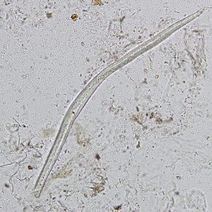 Figure D: Plant hair in a concentrated wet mount of stool. Plant hairs can be common in stool and may be confused for the larvae of hookworm or <em>Strongyloides stercoralis</em>. However, they are often broken at one end, have a refractile center and lack the strictures seem in helminth larvae (esophagus, genital primordium, etc).