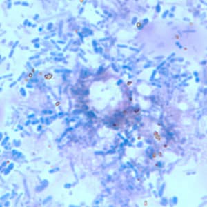 Figure F: Object, probably fungal, in an acid-fast stained stool specimen. Such objects may be confused for the oocysts of <em>Cyclospora</em> spp.