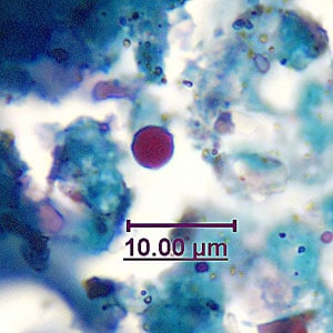 Figure C: Fungal element in an acid-fast stained stool specimen. Such objects may be confused for the oocysts of <em>Cryptosporidium</em> spp. Images courtesy of the Georgia State Public Health Laboratory.