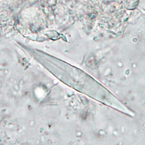 Figure C: Charcot-Leyden crystals. These crystals are the breakdown products of eosinophils and maybe found in the feces and sputum of people with tissue-invading parasitic infections or various allergic reactions.