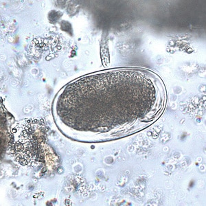 Figure F: Mite egg in a formalin-concentrated stool specimen. Mite eggs are similar to hookworm eggs but are usually larger (but not always). In this specimen, leg buds can be seen in the lower right area of the egg.