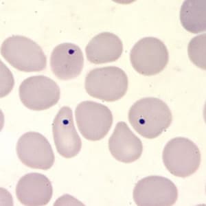 Figure E: Howell-Jolly bodies in a thin blood smear, stained with Giemsa. Howell-Jolly bodies are inclusion that may be seen in splenectomized patients or patients with an otherwise non-functioning or atrophic spleen, and in patients with severe anemia or leukemia.