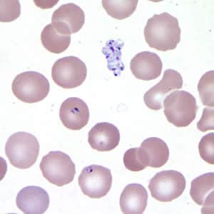 Figure A: <em>Babesia</em> sp. in a thin blood smear stained with Giemsa. Note the clumped extracellular forms indicative of <em>Babesia</em>.