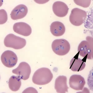 Figure C: <em>Babesia microti</em> in a thin blood smear stained with Giemsa. Note the intra-erythrocytic vacuolated forms indicated by the black arrows.
