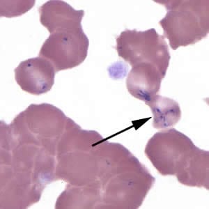 Figure J: <em>Babesia</em> MO-1 in a thin blood smear stained with Giemsa. Note the tetrad (black arrow).