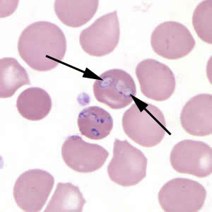 Figure B: <em>Babesia</em> MO-1 in a thin blood smear stained with Giemsa. Babesia sp. cannot be identified to the species level by morphology alone; additional testing, such as PCR, is always recommended. Note the vacuolated parasites (black arrows) in the image.