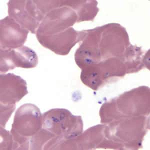  Figure H: <em>Babesia</em> MO-1 in a thin blood smear stained with Giemsa. Babesia sp. cannot be identified to the species level by morphology alone; additional testing, such as PCR, is always recommended.