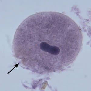 Figure E: <em>B. coli</em> trophozoite in a Mann's hematoxylin stained smear, 500× magnification. Note the cytosome (black arrow) and the bean shaped macronucleus.