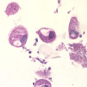 Figure B: <em>B. coli</em> trophozoites in colon tissue stained with hematoxylin and eosin (H&E) at 400x magnification.