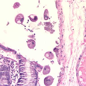 Figure A: <em>B. coli</em> trophozoites in colon tissue stained with hematoxylin and eosin (H&E) at 200x magnification.