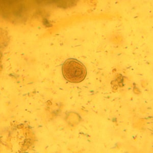 Figure B: Cyst of <em>C. mesnili</em> in a concentrated wet mount of stool, stained with iodine. Image taken at 1000x magnification.