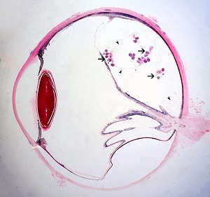 Figure A: Cross-section of a human eye, showing multiple protoscoleces within a coenurus (arrows) and very thin bladder walls (darts).